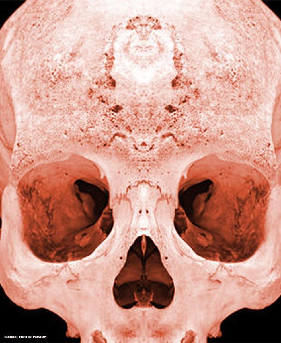 Image of a skull of someone with Syphilis